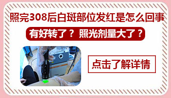 照完308准分子激光白斑部位马上就红吗