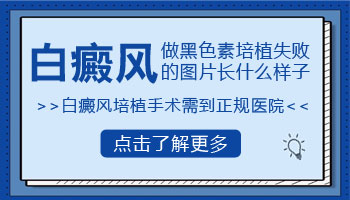 白癜风黑色素种植失败会是什么样