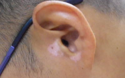 耳朵根部和鼻子两侧晒的起白点怎么回事