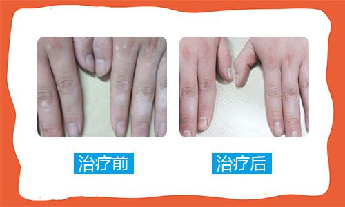 近期发现大拇指有白斑 手指白斑图片