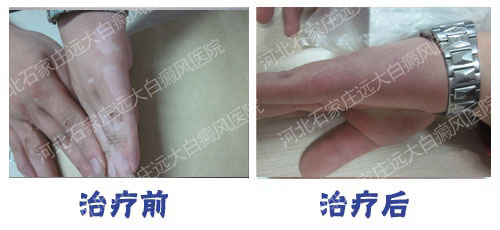 白癜风做完表皮移植皮掉了出汗有事吗