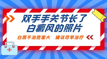 白癜风不医治会导致哪些危害发生呢