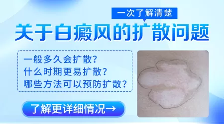 发现白斑一般多久会扩大