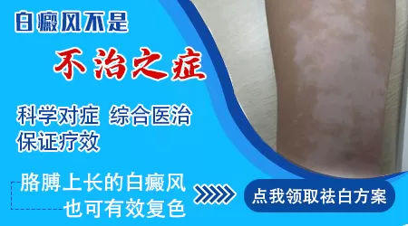 手上一小片白癜风不治会不会长满全身