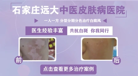 通过白斑颜色怎么辨认白癜风