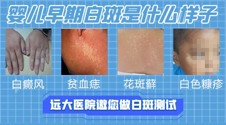 婴儿脖子白斑