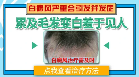 白癜风汗毛变白证明很严重吗