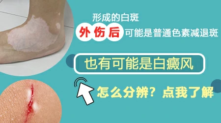 皮肤外伤后出现白斑怎么办