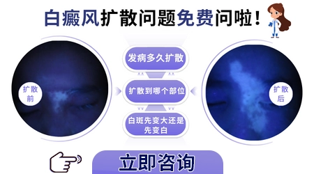 白癜风早期白斑会扩散吗