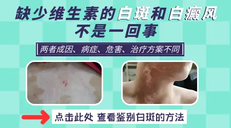 小孩缺少维生素白斑和白癜风的区别