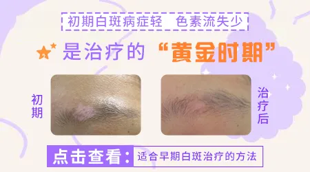 白癜风最初期的图片 能治好吗