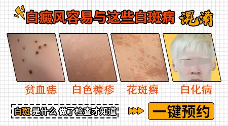 怎么判断白癜风是不是早期