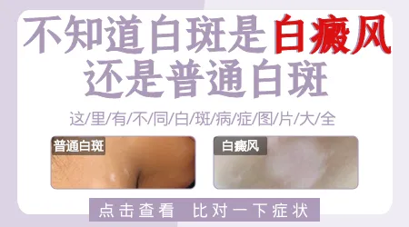 白斑和白癜风是不是一回事
