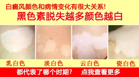白癜风淡白色斑片多久会变成明显的瓷白色