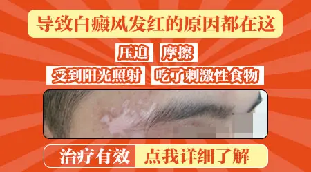白斑在太阳下发红是白癜风吗