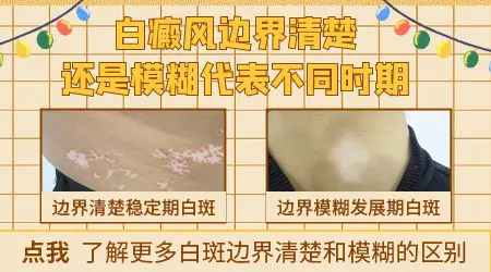 如何判断白癜风处于进展期还是稳定期