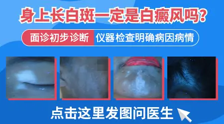 白癜风跟白斑的区分是什么图片