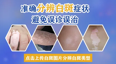 白癜风和白斑外表症状区别图片