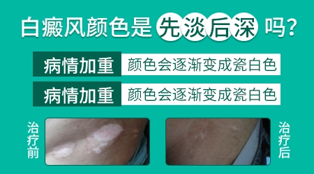 白癜风早期颜色是淡白还是瓷白