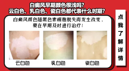 白癜风纯白色和淡白色分别代表什么