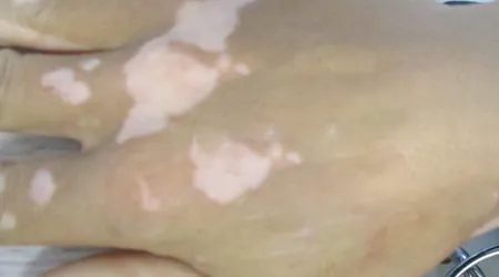 手背大拇指根处有2块白怎么回事