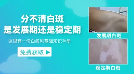 白斑多久没有变化才算进入稳定期