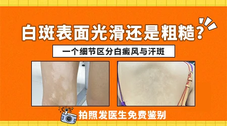 怎么区分白斑是白癜风还是汗斑