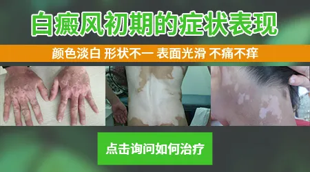 怎么区分白斑是白癜风还是汗斑