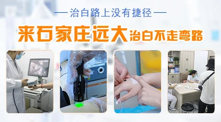 早期白癜风白斑和白色糠疹对比图片