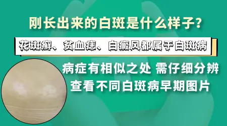 刚发现身上有白片可以先观察吗