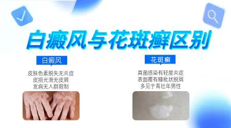 花斑癣和白癜风的白斑有什么不一样