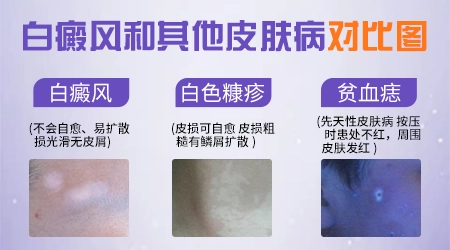 白癜风和白斑的区别是什么图片对比