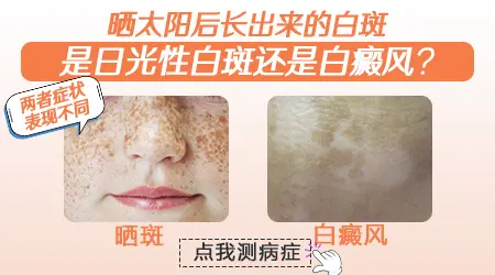 如何区分白癜风与日光性白斑