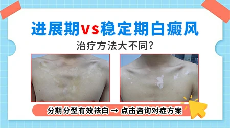 稳定期白斑突然扩散是什么原因