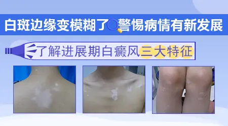 刚长的白斑边界特别模糊是不是说明还在快速进展