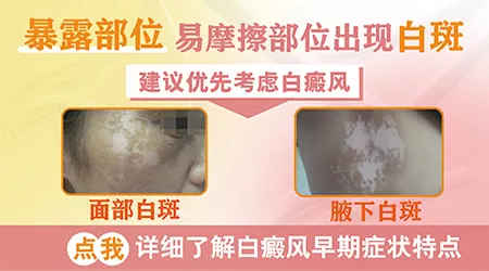 脚踝反复摩擦后发白 警惕外伤型白斑