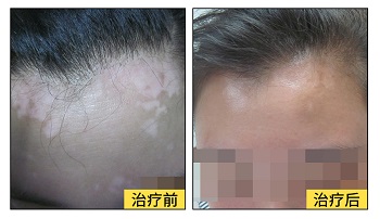 治疗女性白癜风用什么方法好