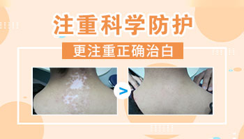 白癜风别的地方又长了怎么办