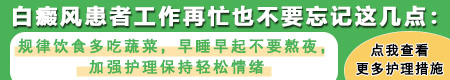 308激光治疗白癜风几次见效