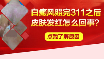 311光疗后白斑区域变红了正常吗