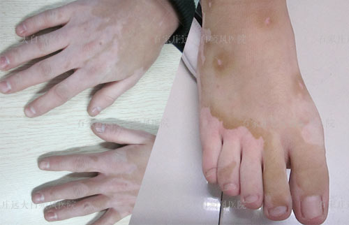 手脚对称性白癜风怎么治疗