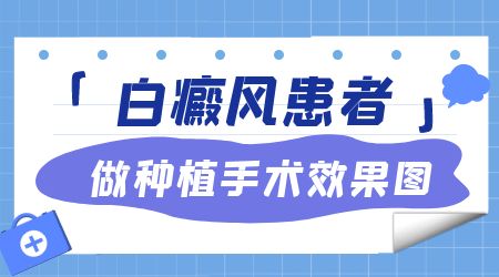 白癜风做什么手术治疗不会留疤