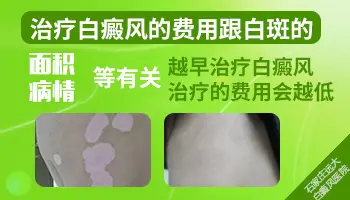 白癜风照308激光一个光斑多大 照一次多少钱