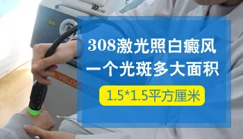 白癜风照308激光一个光斑多大 照一次多少钱