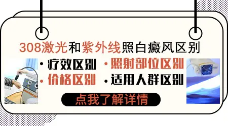 308激光和紫外线照白癜风疗效和价格有什么区别