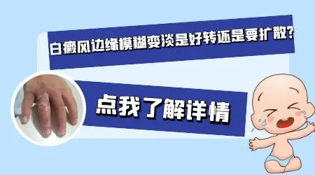 白癜风边界由清晰变淡了