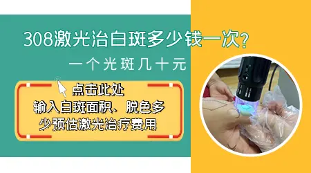 石家庄308激光治疗的费用是多少