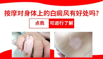 白癜风做耳部穴位管用吗