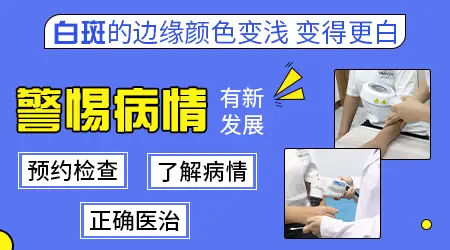 白癜风照308激光6次肉眼能看到效果吗