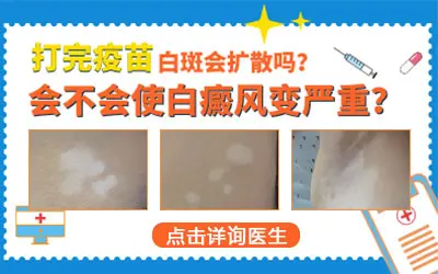 打完新冠疫苗白癜风扩散